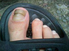 灰指甲的正确护理方法